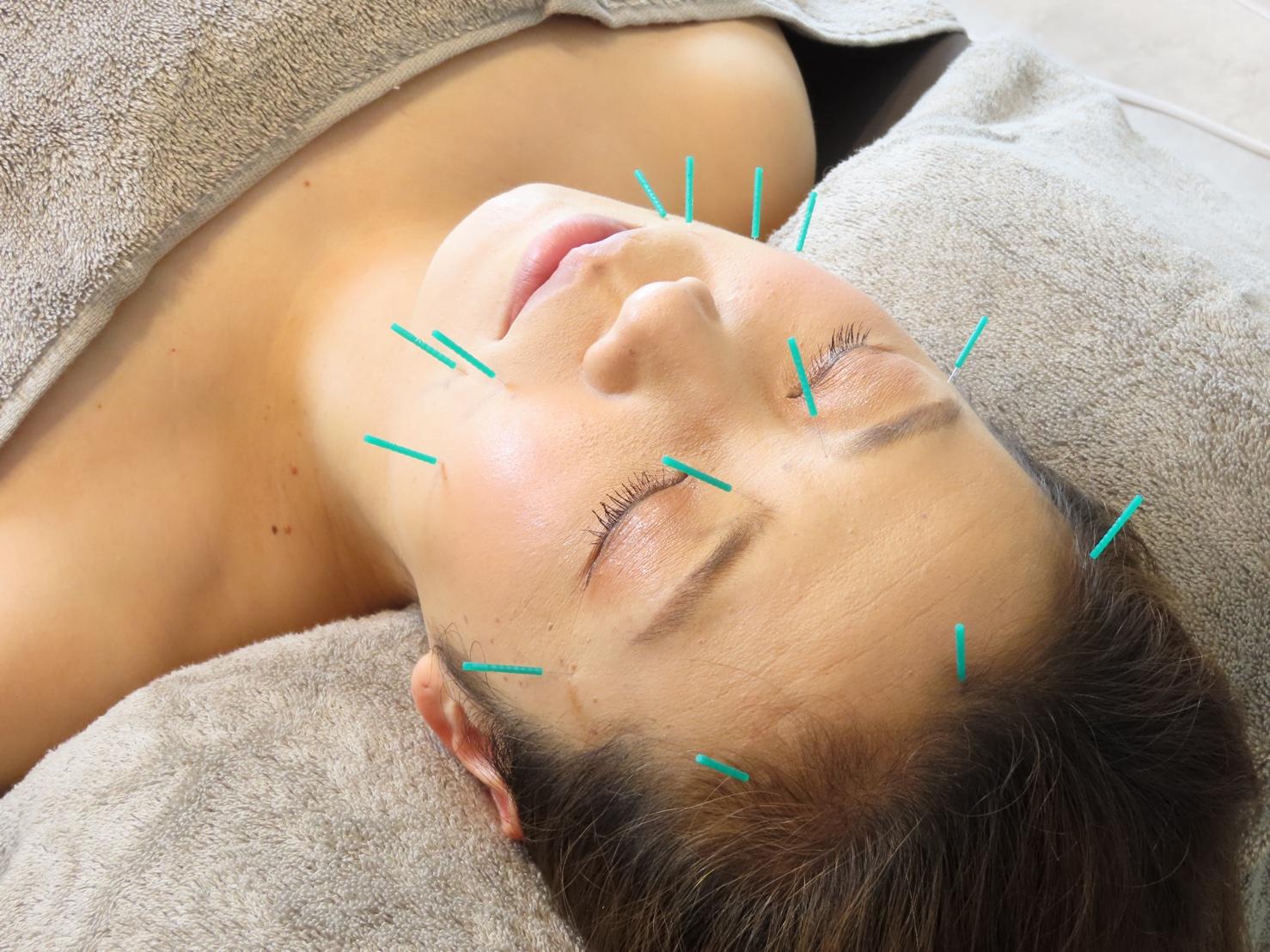 美容鍼施術